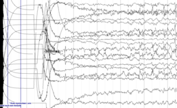 EEG-fragment gedurende ECT-sessie 1