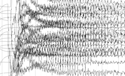 EEG-fragment gedurende ECT-sessie 2