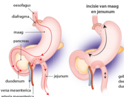 Psychofarmacagebruik en bariatrische chirurgie