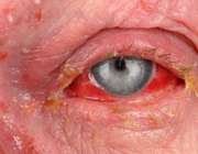 Stevens-Johnson-syndroom en toxische epidermale necrolyse bij gebruik van anti-epileptica