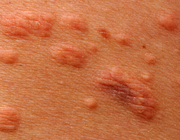 Hypertriglyceridemie door alcoholgebruik